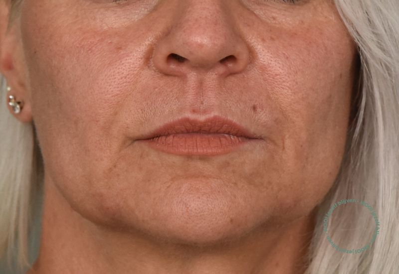 marionetlijntjes fillers