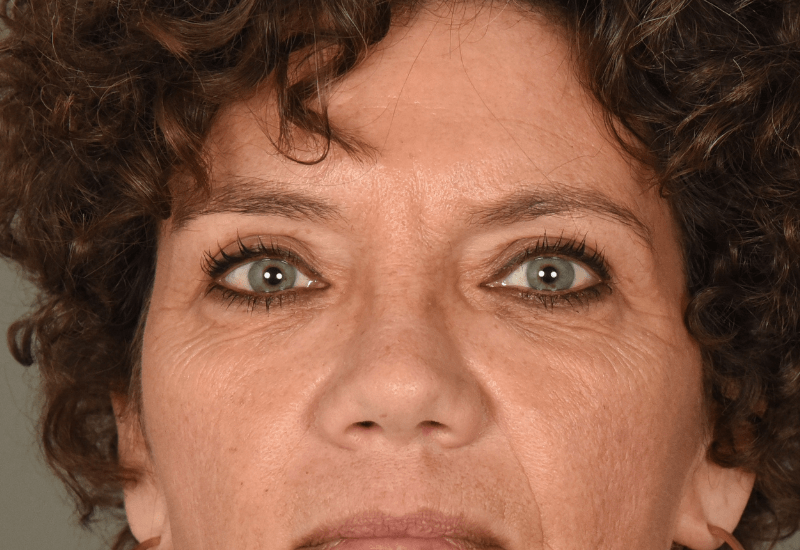 mooie ooglidcorrectie resultaten