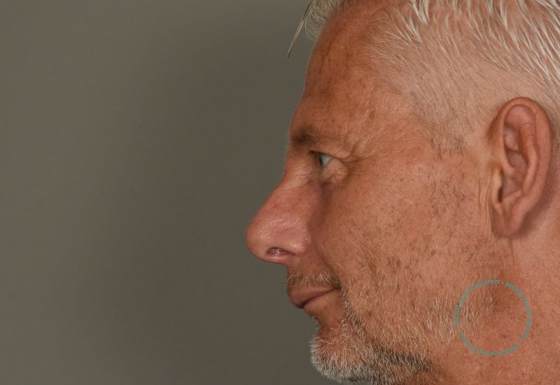 neuscorrectie na foto