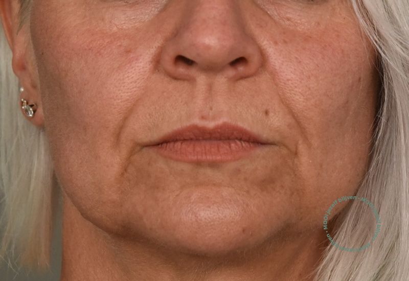 neuslippenplooi fillers