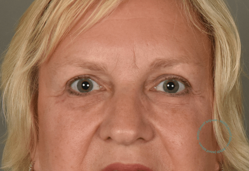 oogleden laten corrigeren