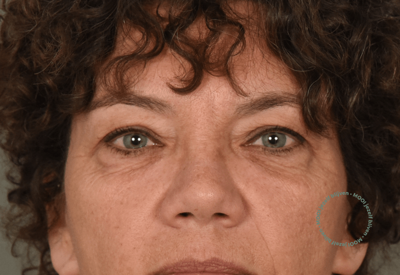 ooglidcorrectie voor operatie