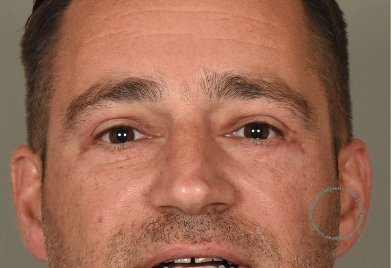 resultaat foto onderooglidcorrectie