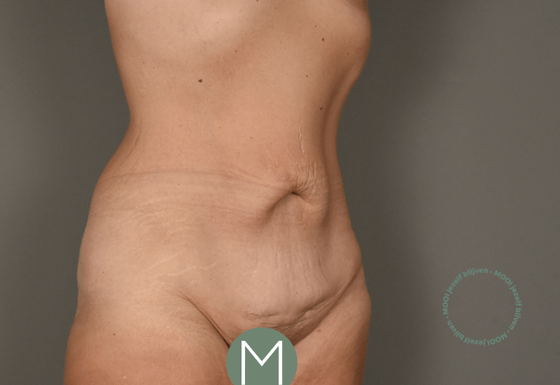 voor buikwandcorrectie slap vel