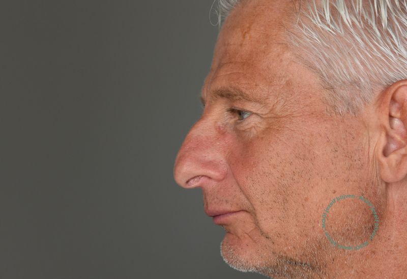 voor foto neuscorrectie man