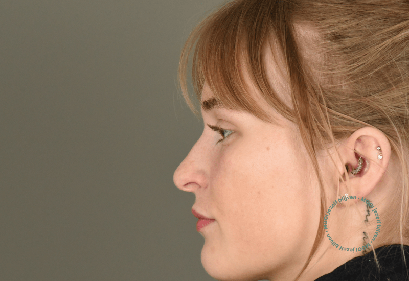 voor foto neuscorrectie