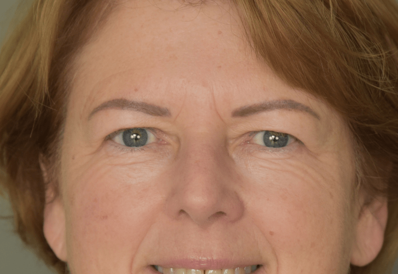 voor foto ooglidcorrectie boven