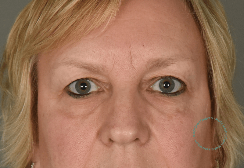 voor overhangende ooglidcorrectie