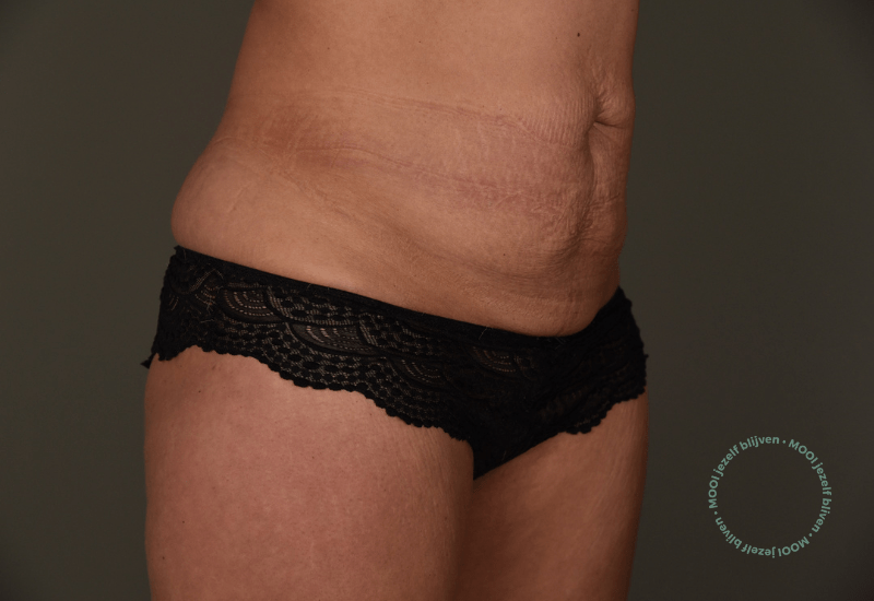 buikwand en lowerbody