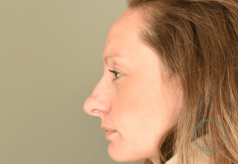 neuscorrectie bobbel lange neus