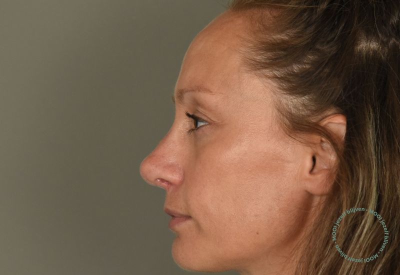 neuscorrectie zonder bobbel