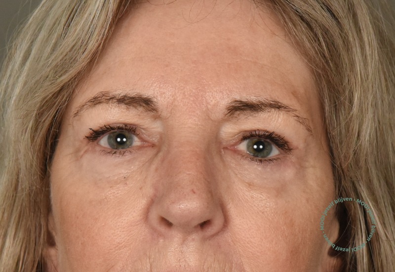 boven en onderooglidcorrectie