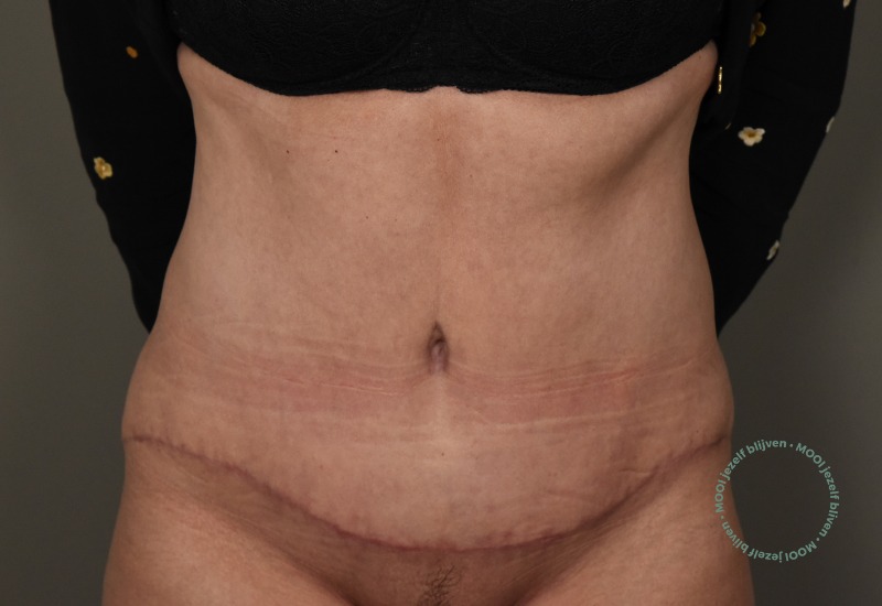 buikwandcorrectie met liposuctie