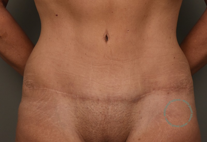 buikwandcorrectie striae verwijderd
