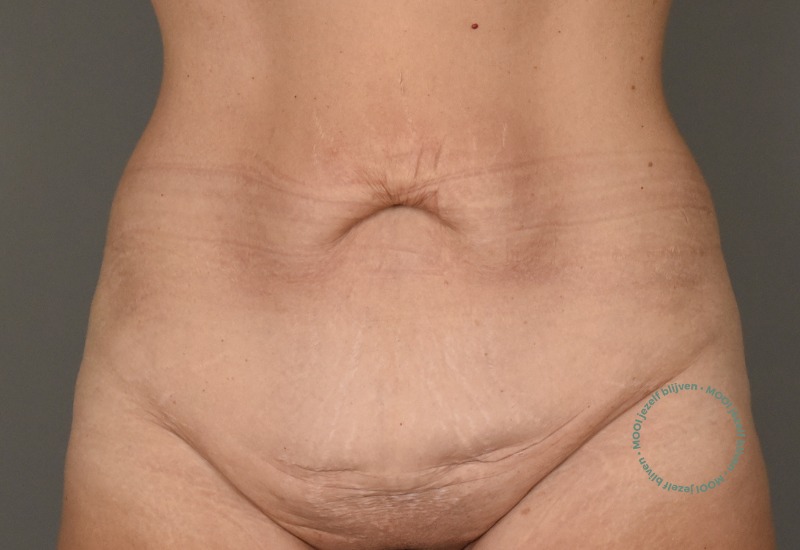 buikwandcorrectie striae