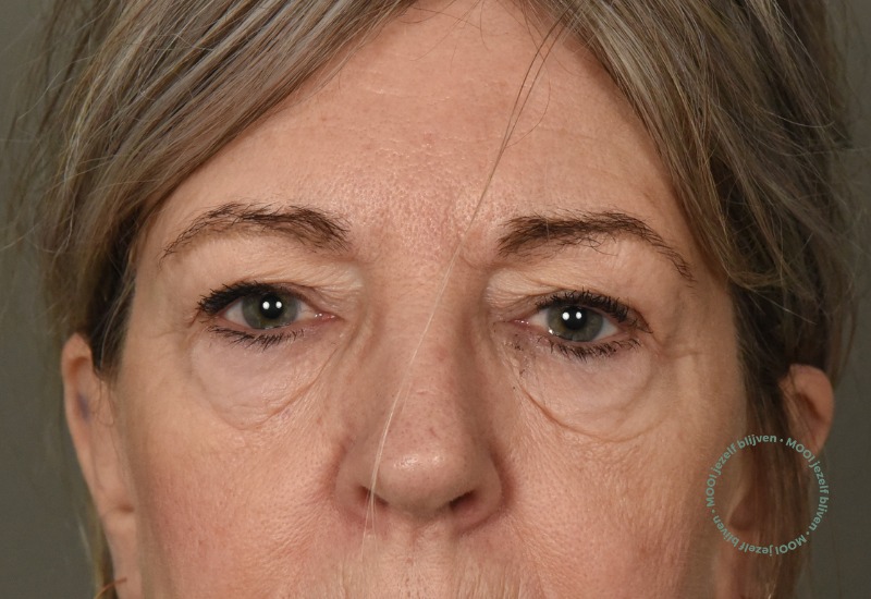 foto voor ooglidcorrectie