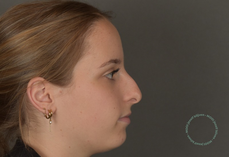 kromme neuscorrectie