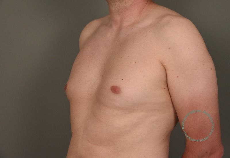 liposuctie borstvorming man