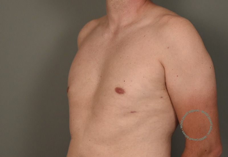 borstlift en prothese wissel