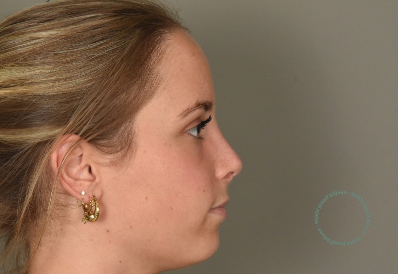 resultaat neuscorrectie