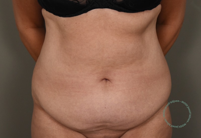 voor liposuctie buik
