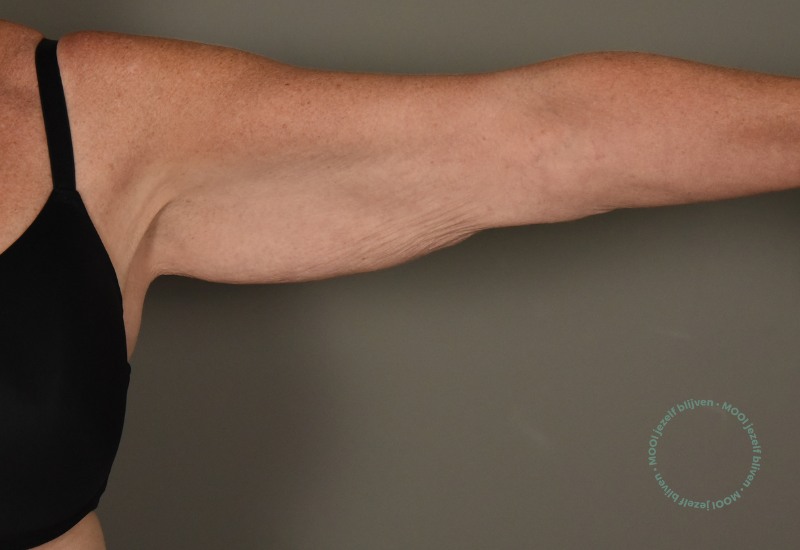 armen armlift operatie