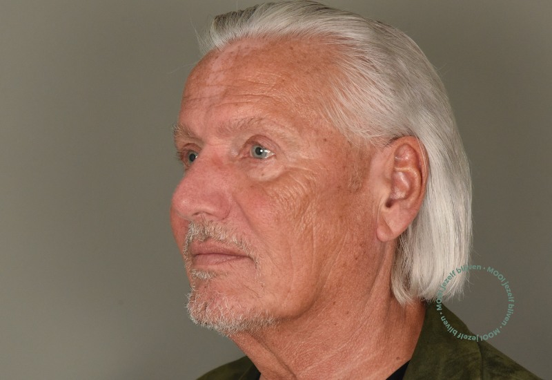 facelift man voor en na