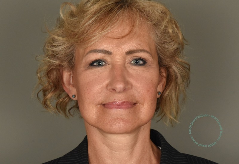facelift na foto vrouw