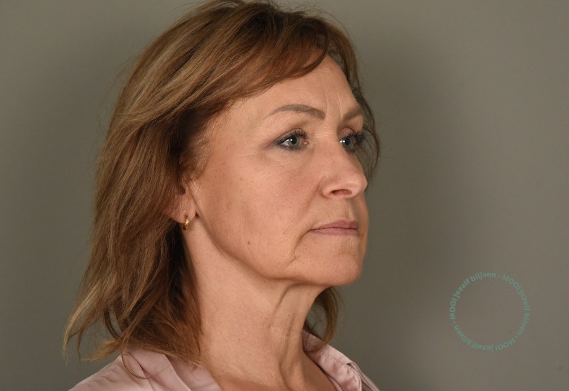 hamsterwangen facelift