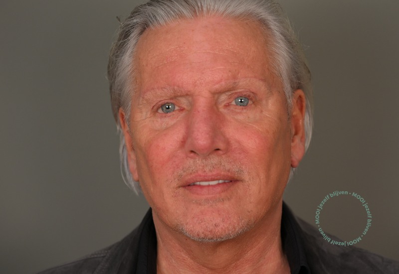 na foto facelift man