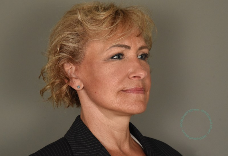 facelift zijaanzicht hals