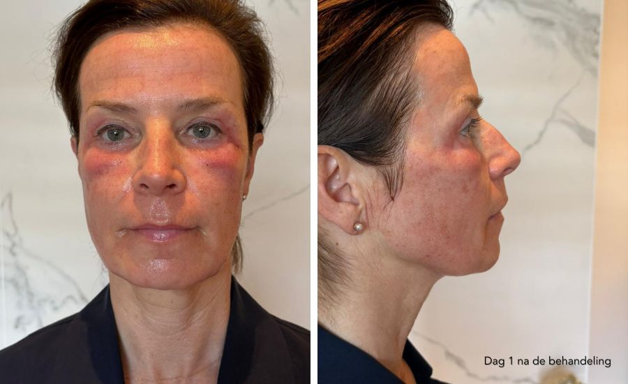 herstel dag 1 profractional laser