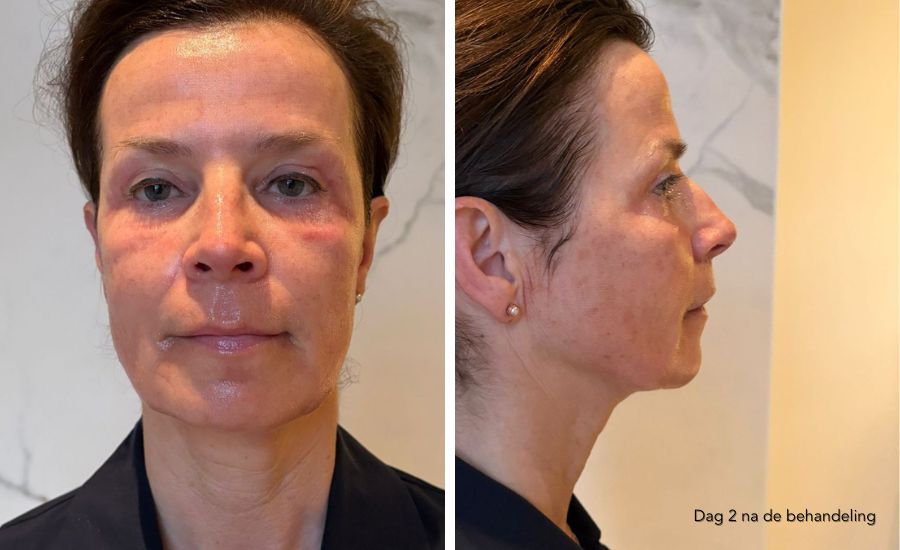 herstel dag 2 ProFractional