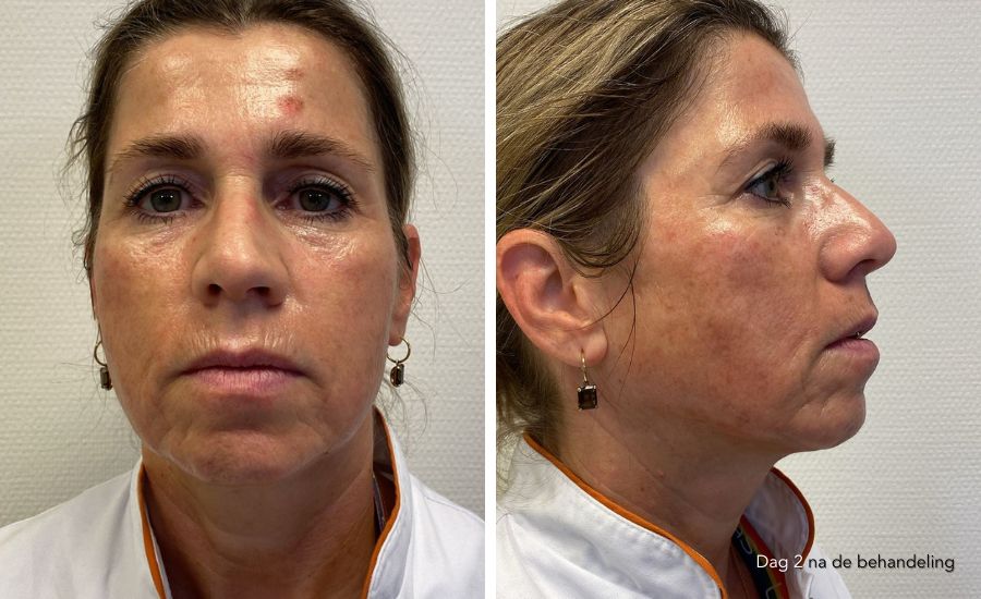 herstel dag 2 nanopeel