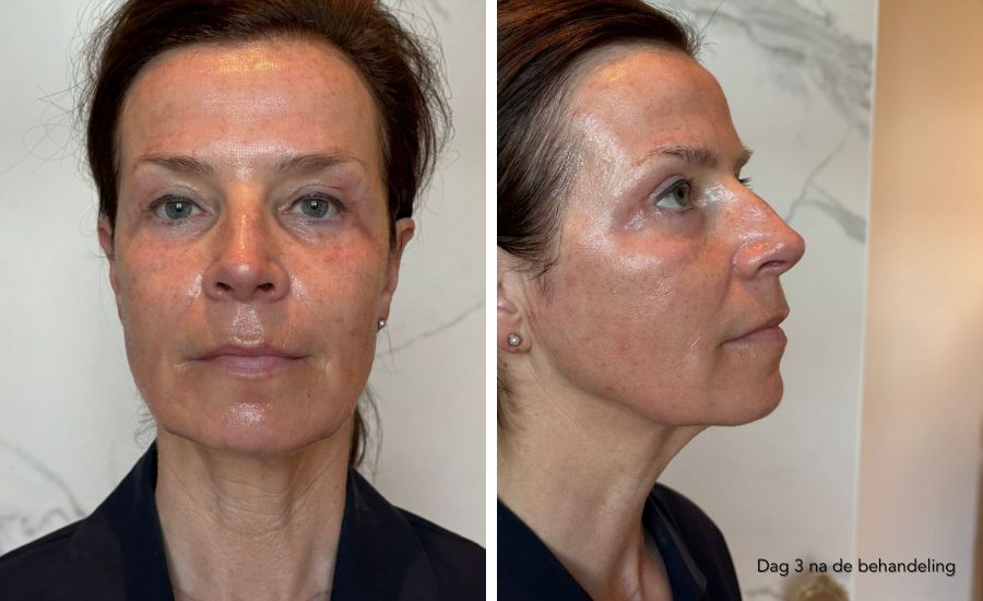 herstel dag 3 ProFractional