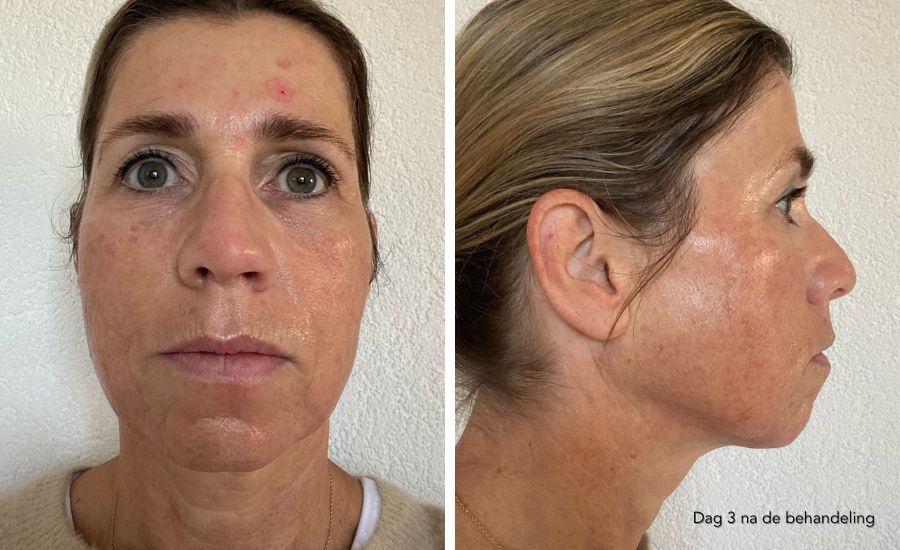 herstel dag 3 nanopeel