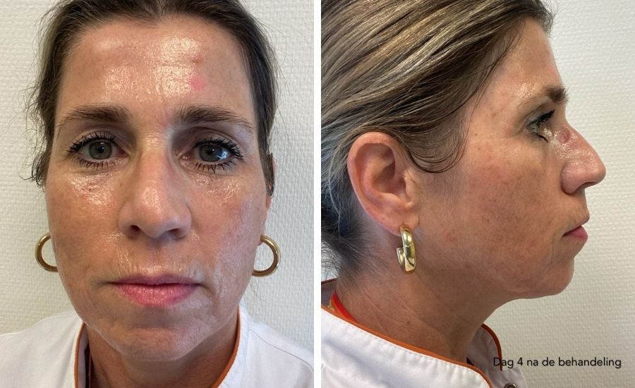herstel dag 4 nanopeel