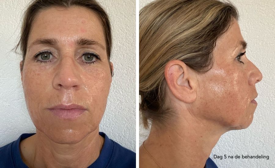 herstel dag 5 nanopeel