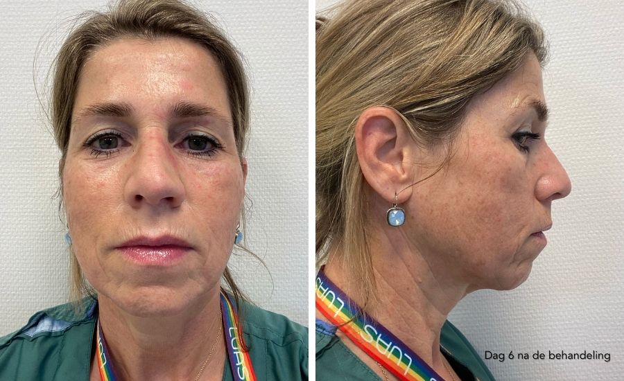 herstel dag 6 nanopeel