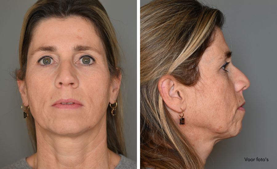 voor foto trl nanopeel laser voor foto trl nanopeel laser