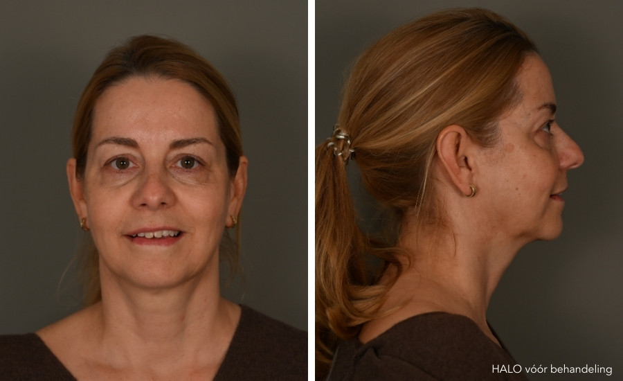 halo laserbehandeling voor foto