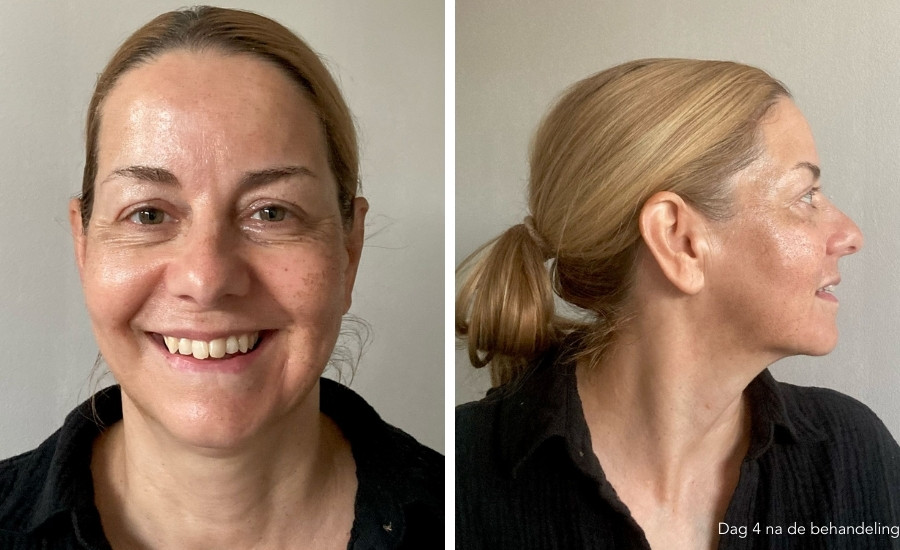 herstel halo laser behandeling
