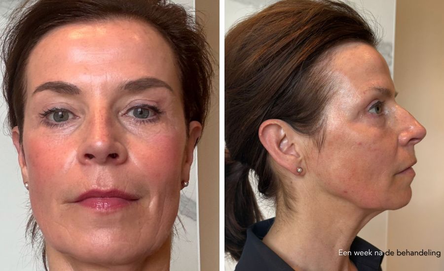 laserbehandeling na 1 week