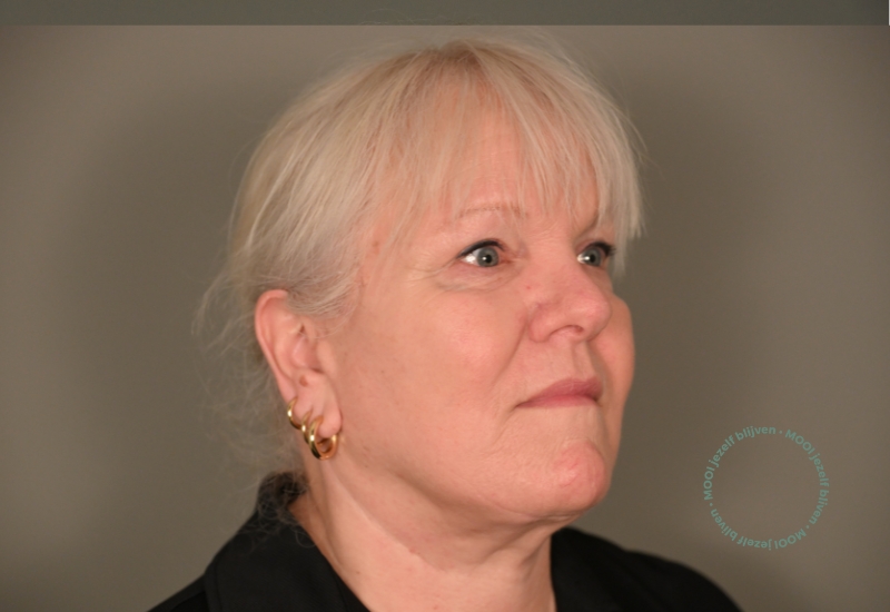 na foto halslift facelift