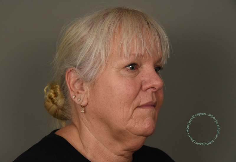 voor foto halslift facelift