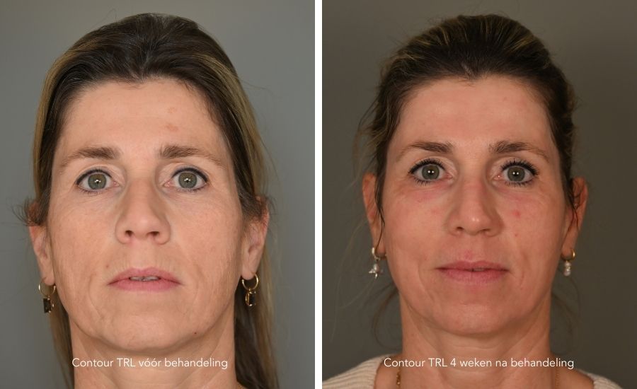 diepe laserpeel resultaat 4 weken