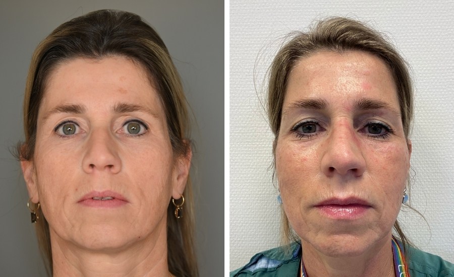 nano laser peel resultaat