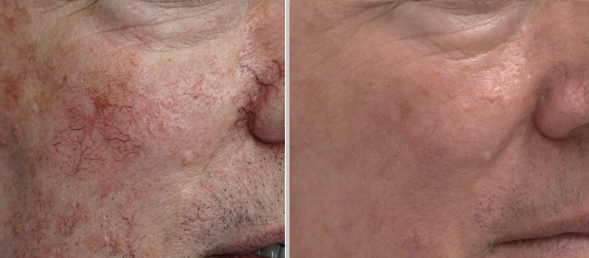 rosacea neus laser