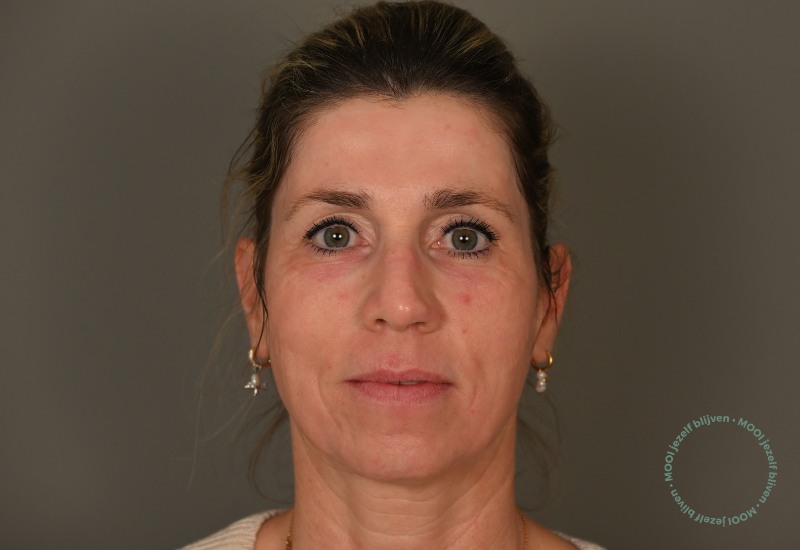 anti rimpel behandeling laser