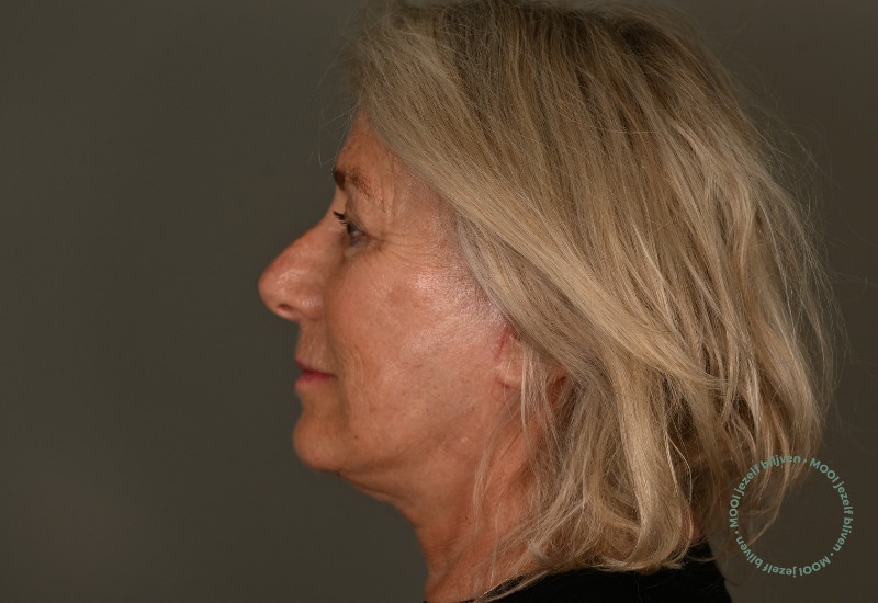 na foto zijaanzicht deep plane lift